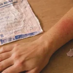 Peau plaque rouge : allergie, eczéma ou urgence